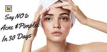 Cure Acne (Pimples) in 30 Days