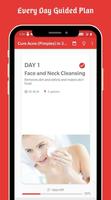 Cure Acne (Pimples) in 30 Days poster