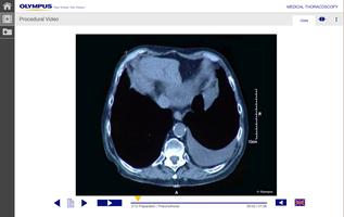 Medical Thoracoscopy imagem de tela 1