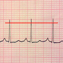ECG Reader 2 free APK