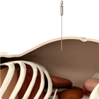 Pneumoperitoneum in humans icon