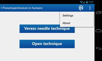 Pneumoperitoneum in humans screenshot 1