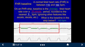 Fetal Heart Rate - SecondLook captura de pantalla 2