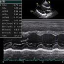 Misure ecocardiografiche APK