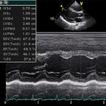 Misure ecocardiografiche