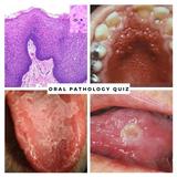 Oral Pathology Quiz