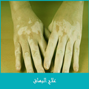 علاج البهاق APK