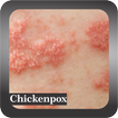 Recognize Chickenpox Disease