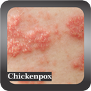 Recognize Chickenpox Disease APK