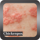 Recognize Chickenpox Disease 圖標