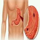 Ulcers Natural Remedies-APK