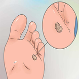 درمان خانگی پینه و میخچه