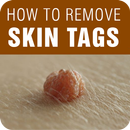 Skin Tag Removal - How to Remove Skin Tags APK