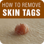 Skin Tag Removal - How to Remo