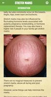 Get rid of Stretch Marks ảnh chụp màn hình 1