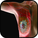 Symptoms of Breast Cancer APK