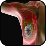 Symptoms of Breast Cancer