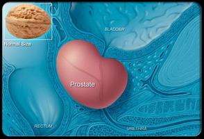 Prostate Cancer Symptoms Affiche