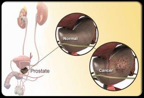Prostate Cancer Symptoms capture d'écran 2