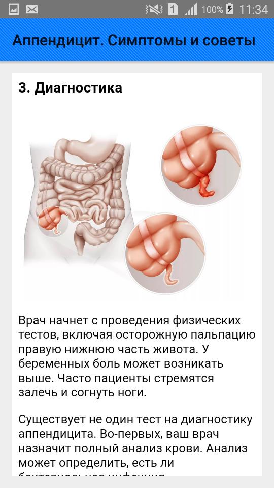 Как проверить аппендицит у взрослого