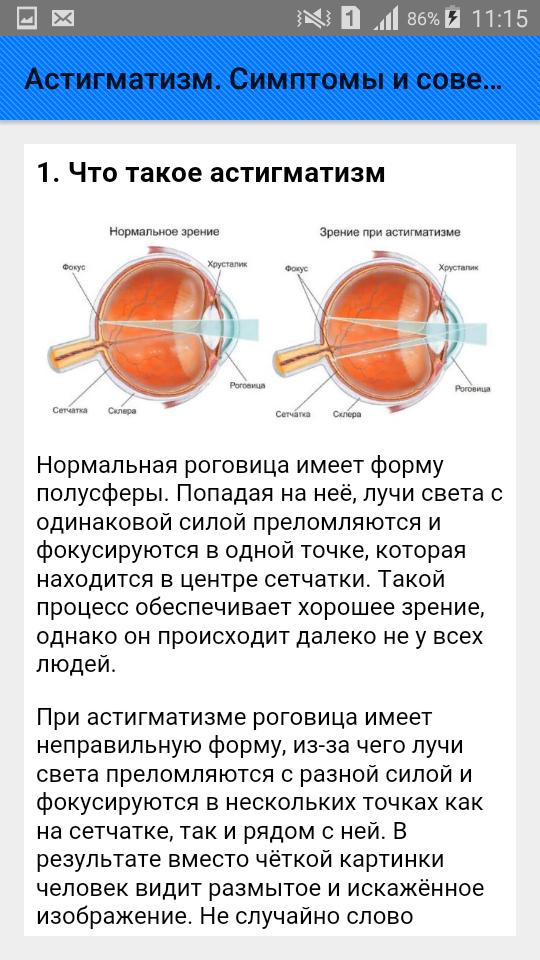 Миопия астигматизм глаз. Дальнозоркий астигматизм у детей. Миопический роговичный астигматизм. Смешанный миопический астигматизм. Гиперметропический астигматизм у детей.