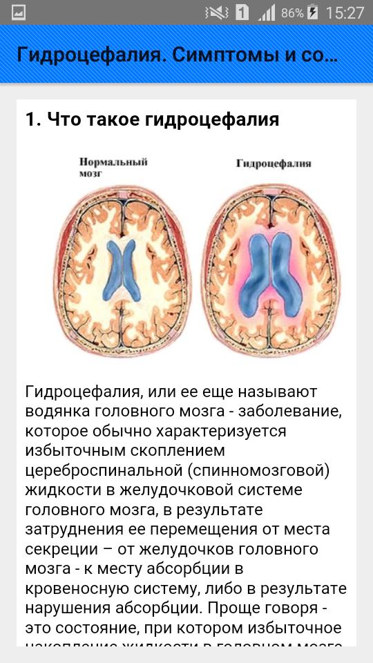 Гидроцефалия мозга симптомы и лечение