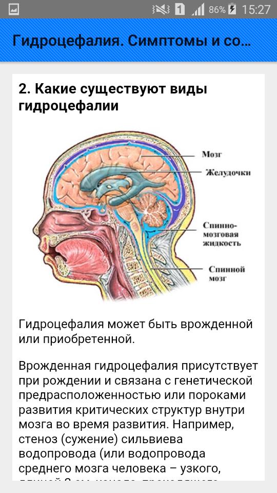 Причины гидроцефалии мозга