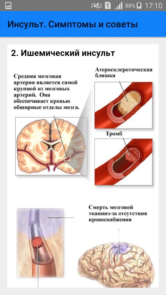 Почему бывает инсульт