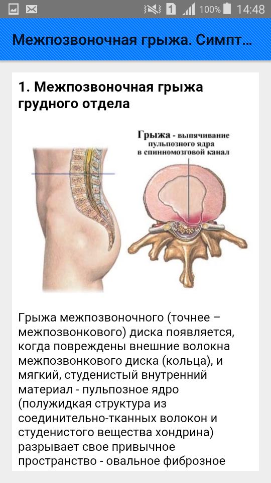 Грыжа поясничного отдела лечение у мужчин симптомы