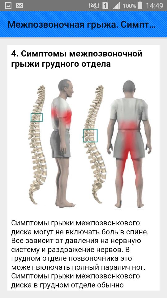 Грыжа поясничного отдела лечение у мужчин симптомы. Межпозвоночная грыжа. Межпозвоночная грыжа симптомы. Позвоночная грыжа симптомы. Грыжа позвоночника симптомы.