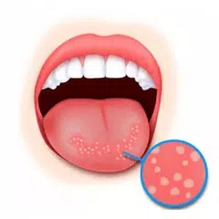 Стоматит. Симптомы и советы