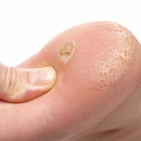 Натоптыши. Лечение, советы aplikacja