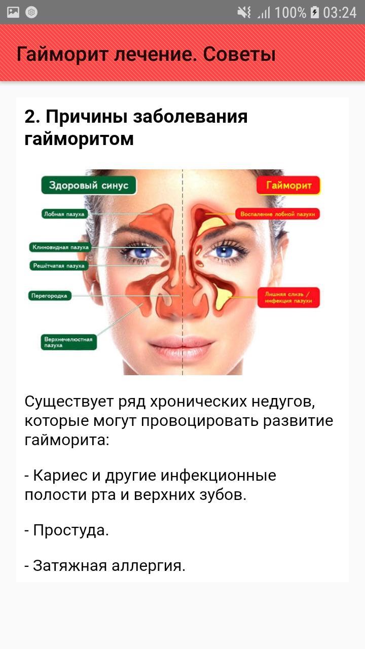 Гайморит лекарства. Синусит и гайморит лекарство. Как лечить дома гайморит быстрые и эффективные