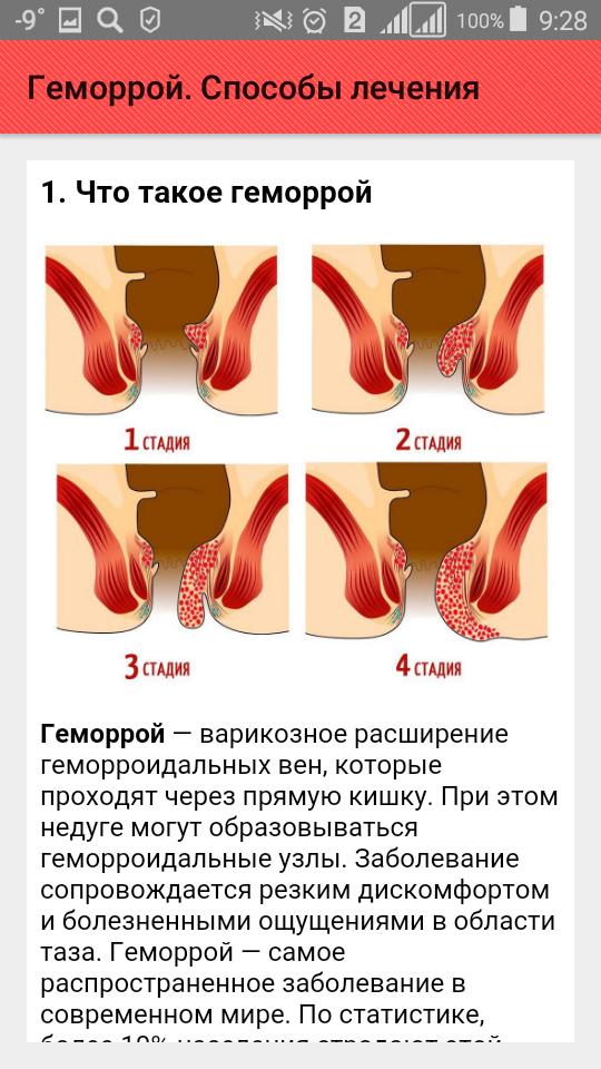 Геморрой причина появления у мужчин лечение