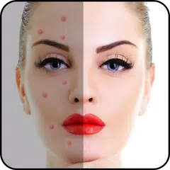 Скачать Acne Free : Pimple Remover APK