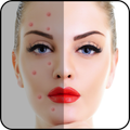 Acne Free : Pimple Remover