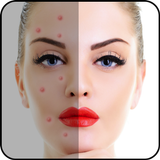 Acne Free : Pimple Remover icône