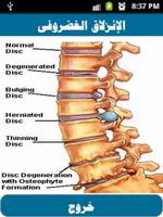 علاج الإنزلاق الغضروفى screenshot 1