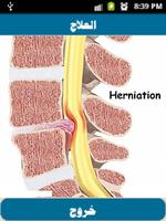 3 Schermata علاج الإنزلاق الغضروفى