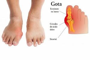 Uric acid tips. Remedies 👣 screenshot 1